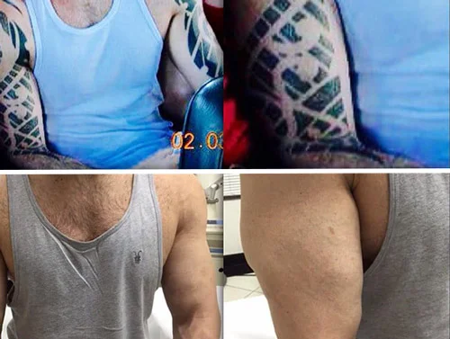Resultado remoção 9